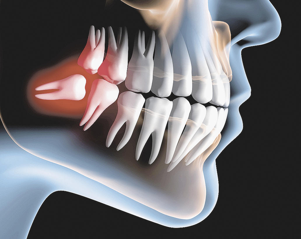 Saiba mais sobre os Dentes do siso