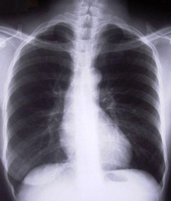 O resultado é uma infinidade de infecções que comprometem o trato respiratório superior (até a orofaringe e traqueia) e inferior (brônquios e pulmões) - Divulgação
